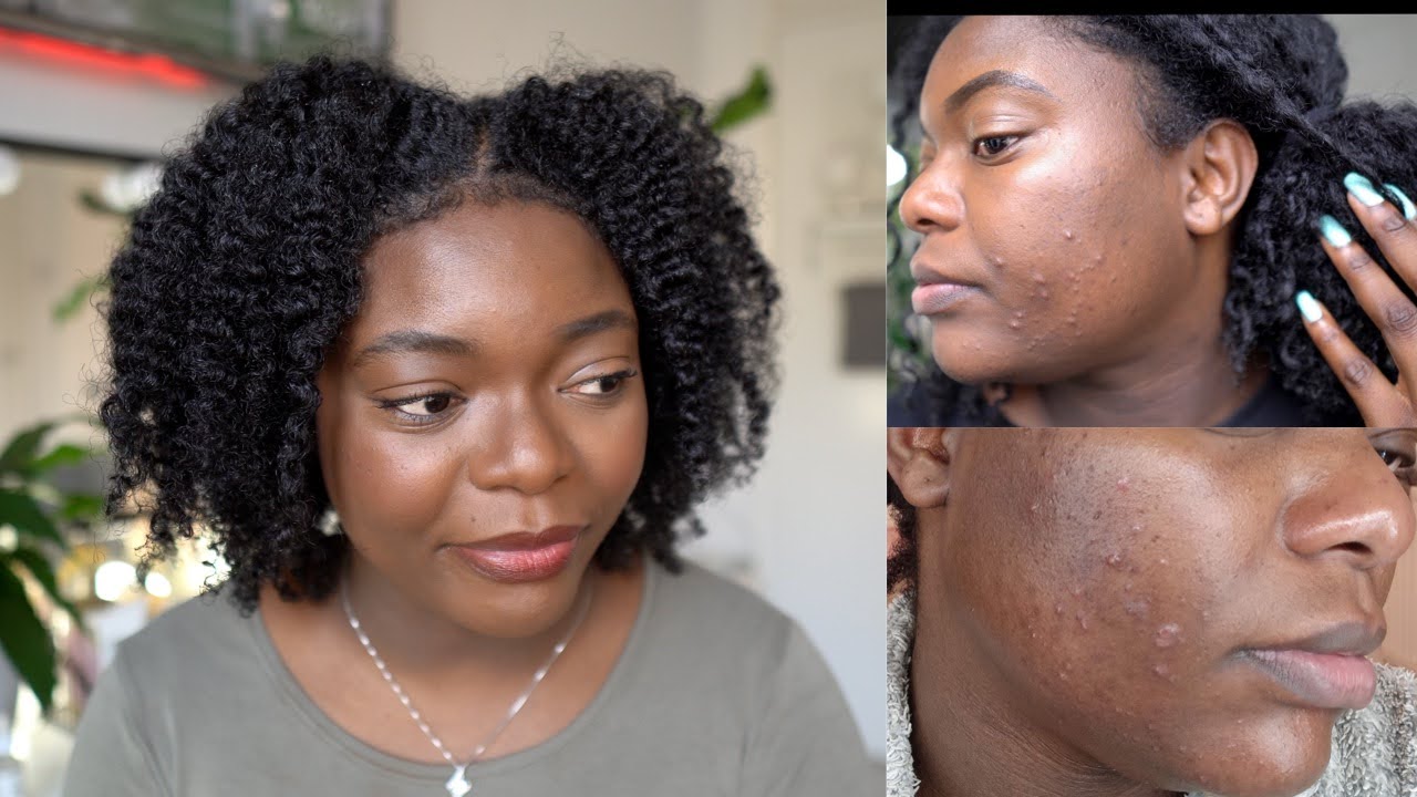 3 Unbelievable Ingredients That Helped Cure My Acne- AQ Online