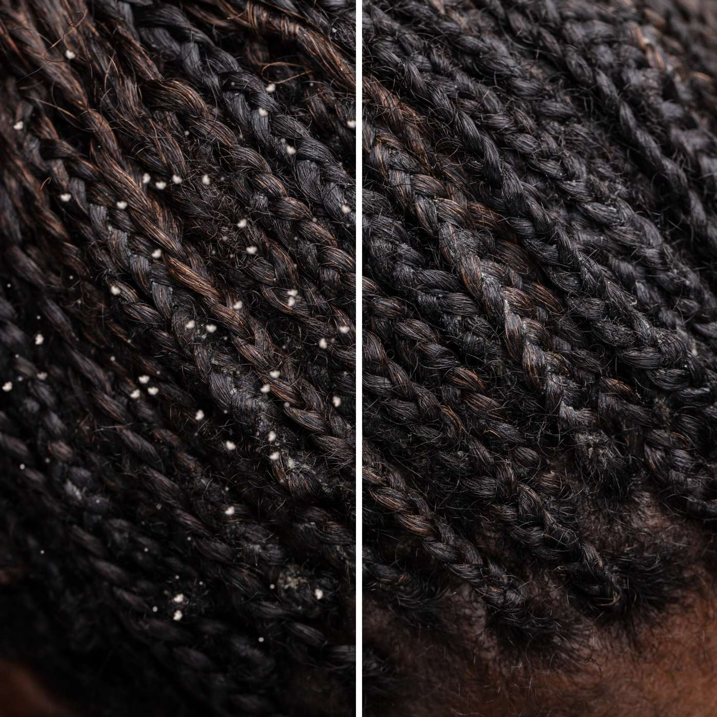 Dandruff and Itchy scalp for natural hair- AQ Online